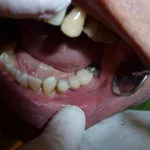 Jak otworzyć zamek w aparacie ortodontycznym