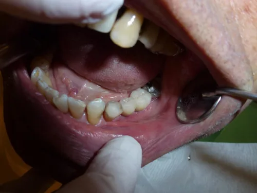 Czym są białe plamy na zębach?